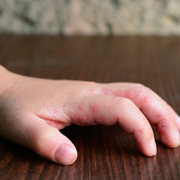 8 first-line treatment options for atopic dermatitis in infants