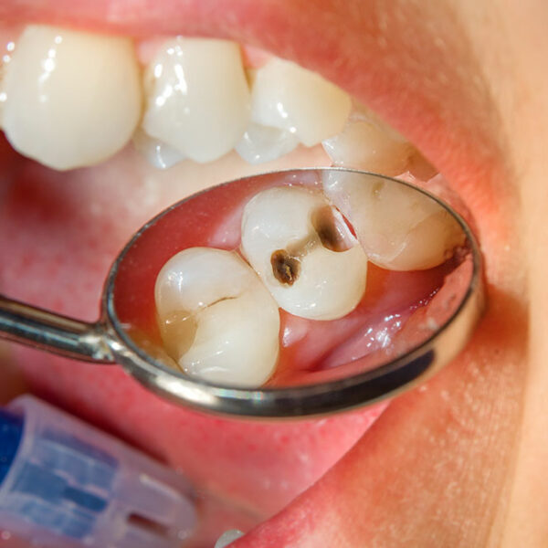 8 signs of dental issues due to high sugar intake